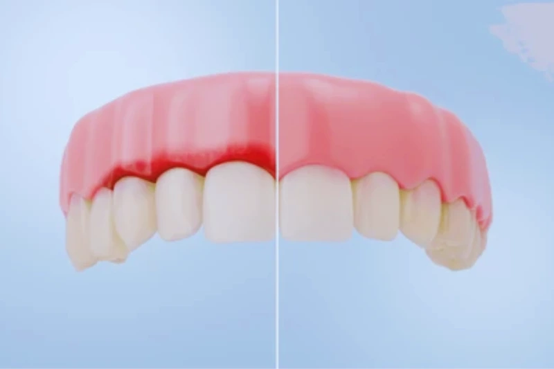 alt="bleeding gums caused by plaque buildup"