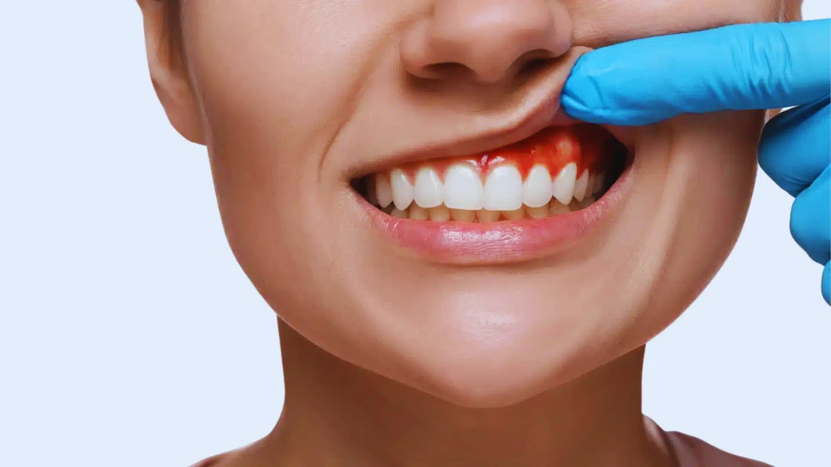 Why Do My Gums Bleed?