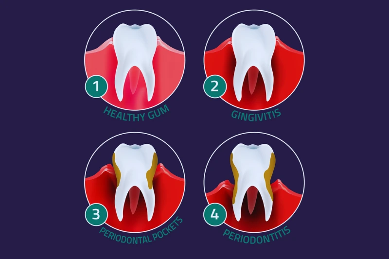 alt="signs of gum inflammation and bleeding"