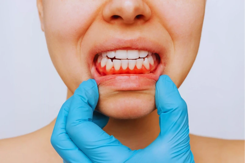 What Is Gum Disease?